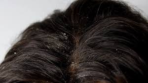 Human hair with dandruff