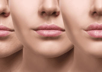 Thin Vs fuller lips