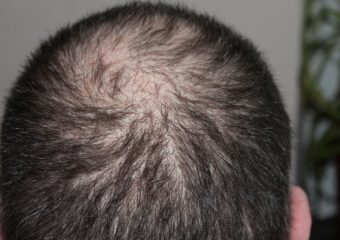man-hair loss
