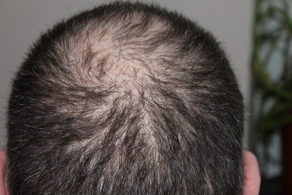man-hair loss