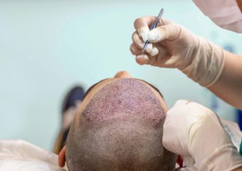 FUE hair transplant