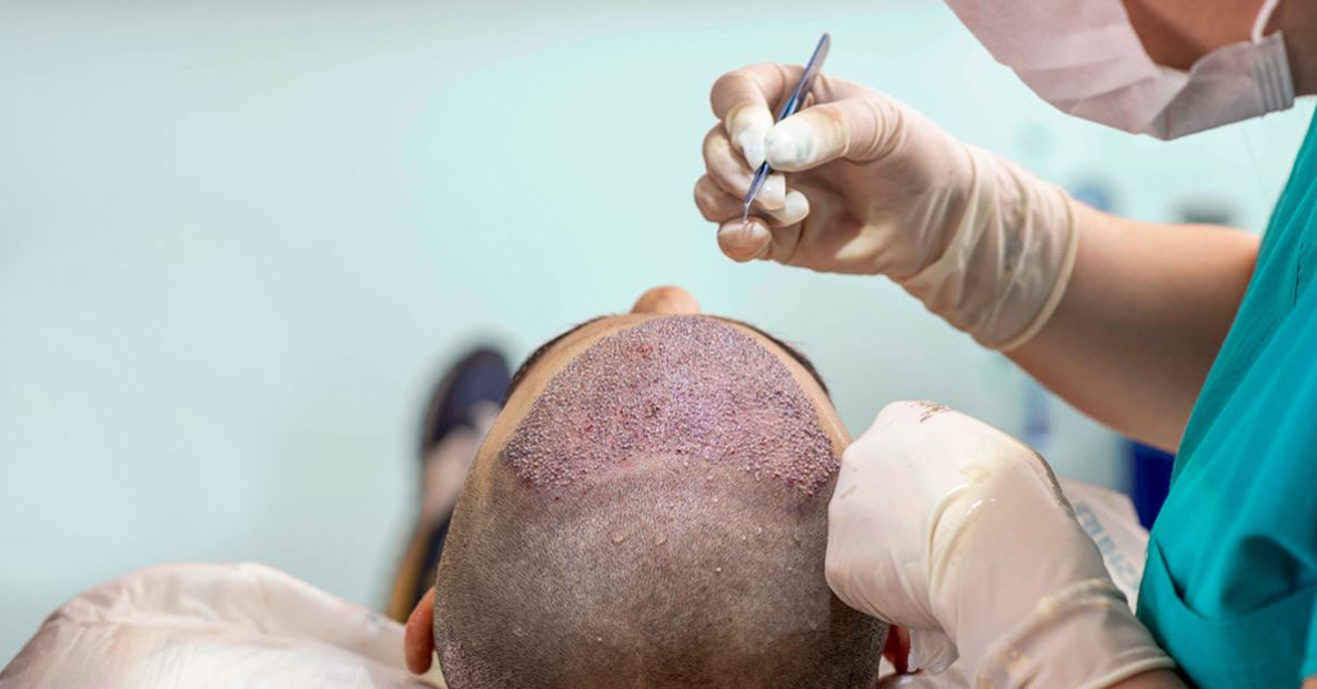 FUE hair transplant